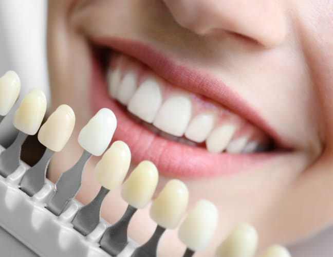 Teeth Whitening, Southcommon Dental, Mississauga